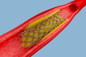 stenting