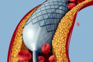 angioplasty