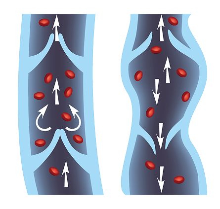 Causes of Chronic Venous Insufficiency