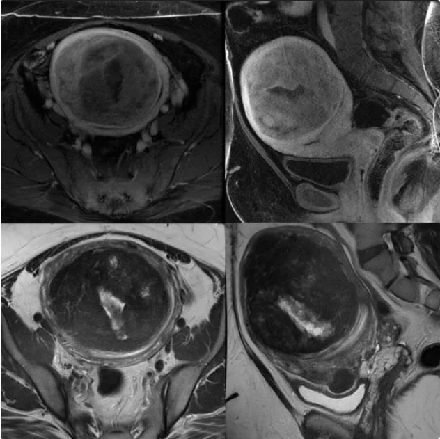 genicular artery embolization