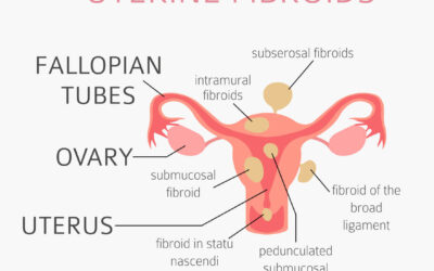 Is Uterine Artery Embolization Right for Me? Exploring Treatment Options for Fibroids