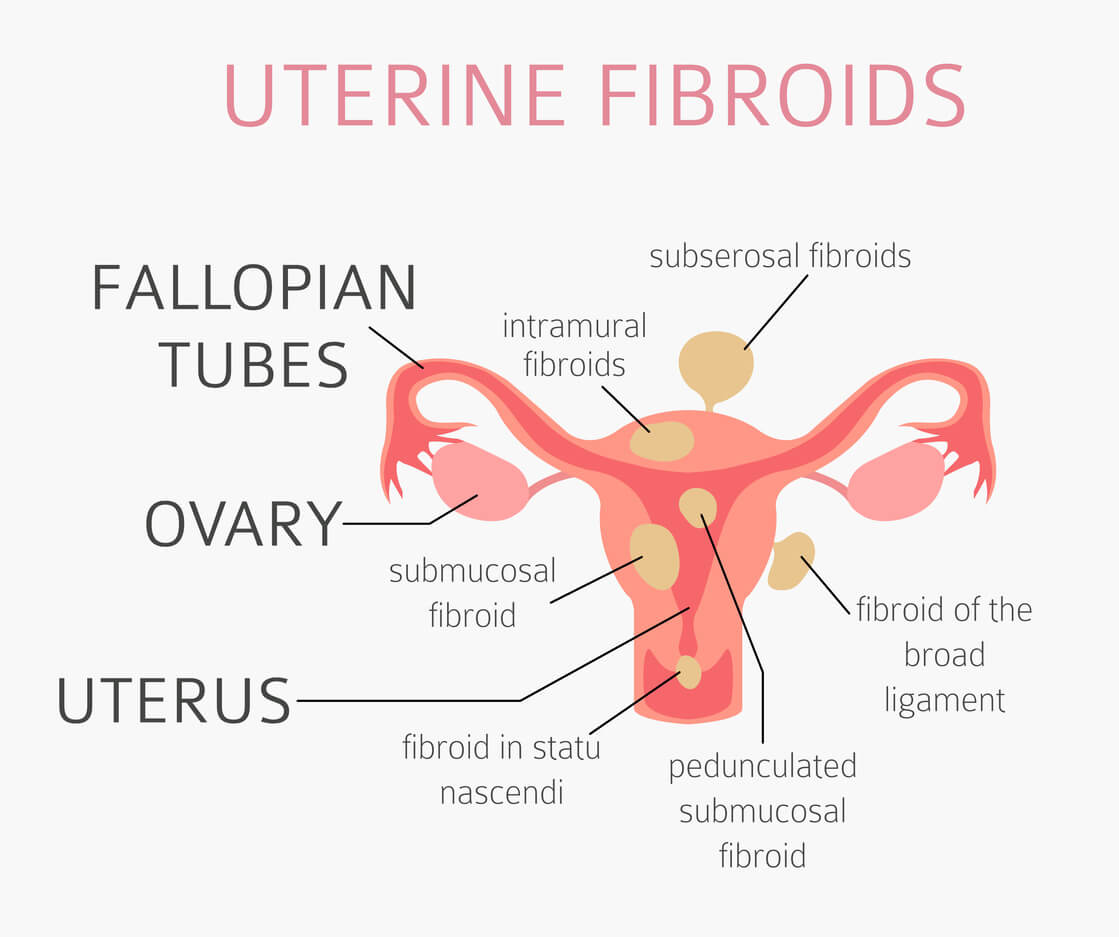 Large-Fibroids-1