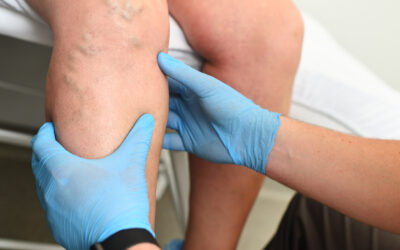 Do You Need a Vein Doctor? Signs and Symptoms of Vein Disease